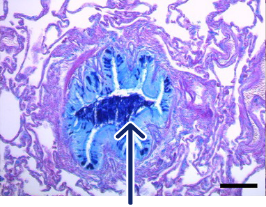 fritzsching-histo-copd